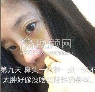 上海喜美徐文龙医生做的*