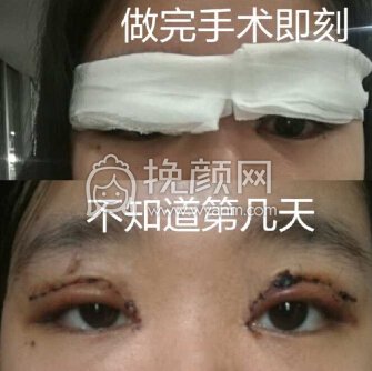 厦门大学附属第一医院樊树强全切＋开眼角