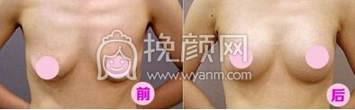 乳房下垂变形怎么办