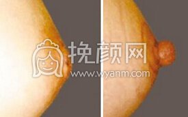 乳头凹陷也能手术你知道吗