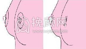 乳头凹陷也能手术你知道吗