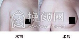 副乳切除术后注意事项有哪些