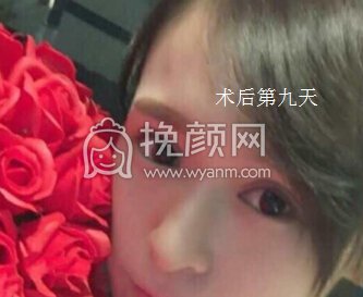 武汉思美妍美容坐诊专家田教授做的五点环绕