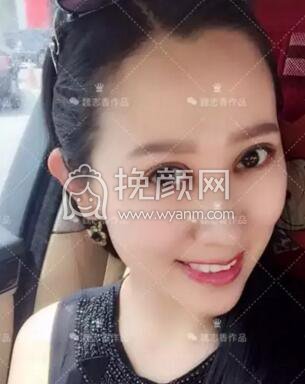 北京悦丽汇医疗美容真人案例