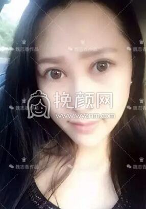 北京悦丽汇医疗美容真人案例