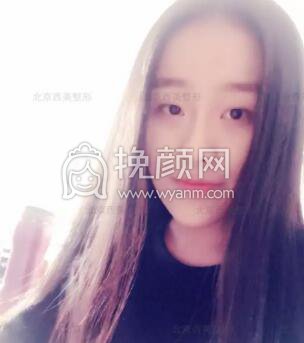 给大家分享一下我的非手术双眼皮心得体会吧