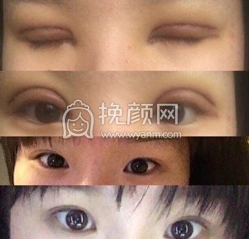 深圳鹏爱医疗美容徐院长全切双眼皮+内眼角