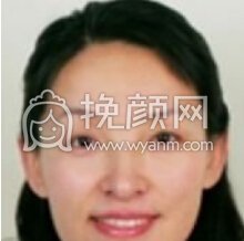 北京八大处整容医院王玉华牙齿微创美容技术好