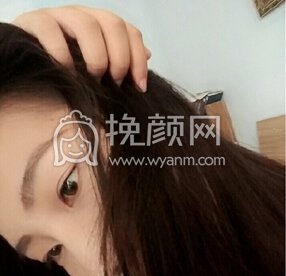 武汉爱思特余萌医生做的全切+开眼角