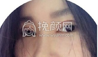 苏州美莱整形医院吴静全切开眼角+上眼提肌