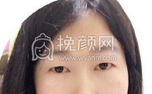 苏州美莱整形医院吴静全切开眼角+上眼提肌