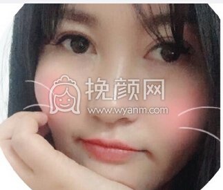 苏州美莱整形医院吴静全切开眼角+上眼提肌