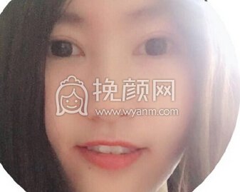 苏州美莱整形医院吴静全切开眼角+上眼提肌