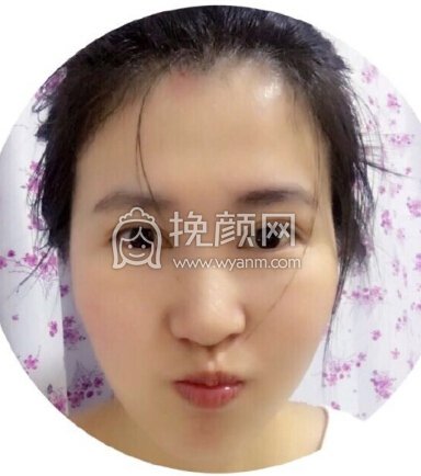 苏州美莱整形医院吴静全切开眼角+上眼提肌