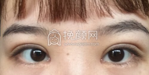 武汉天佑医院李芸主任做的三点微创双眼皮、内