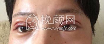 成都素美杨迪院长帕克全切调整上眼睑下垂