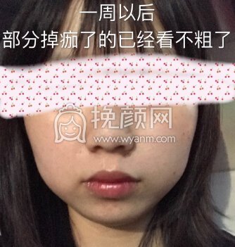 深圳北大医院皮肤科叶蓉主任激光点痣