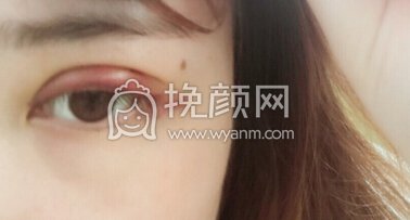 长沙美之峰刘磊医生做的韩式三点双眼皮