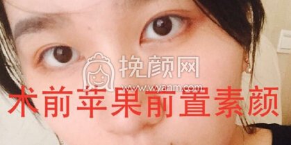 成都华美陈扬主任做的双眼皮+开眼角+提肌