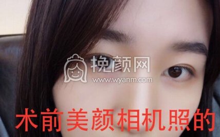 成都华美陈扬主任做的双眼皮+开眼角+提肌