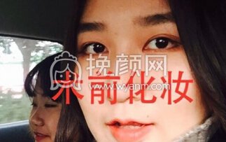 成都华美陈扬主任做的双眼皮+开眼角+提肌