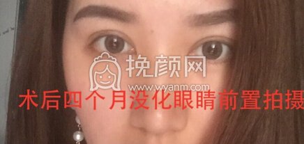 成都华美陈扬主任做的双眼皮+开眼角+提肌