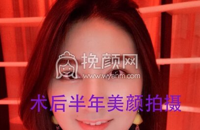 成都华美陈扬主任做的双眼皮+开眼角+提肌