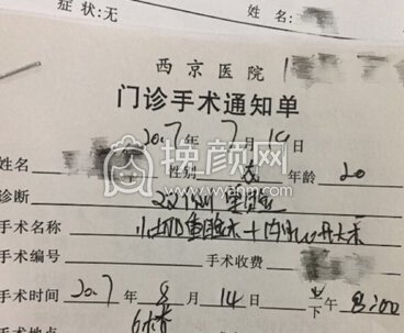 西京医院李杨医生小切口+内眼角