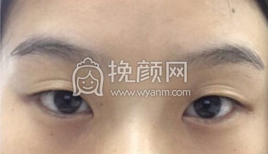 上海曙光医院朱华锋医生全切双眼皮＋开眼角