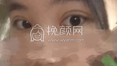 上海美联臣安薇院长做的全切双眼皮