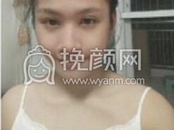 福州优医联合医美王立敏做的全切双眼皮+开内眼