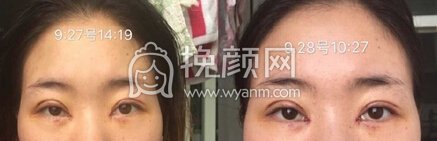 潍坊医学院整形外科医院杨彪炳帕克全切+开眼角