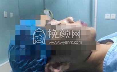 上海美仑整形*，耳软骨垫鼻尖+硅胶鼻梁