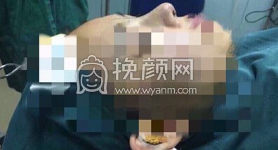 上海美仑整形*，耳软骨垫鼻尖+硅胶鼻梁