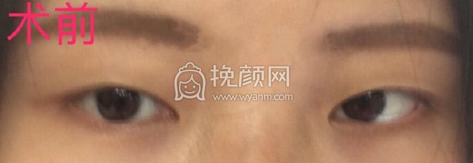 云南昆明华美美莱杨主任做的韩式全切+开内眼角