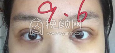 成都华颜美容整形张蕾双眼皮全切+开眼角