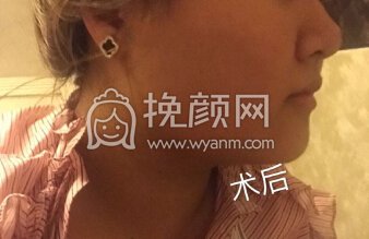 长沙伊美唐中华面部吸脂