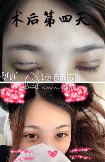 河南郑州美莱医院张主任做的全切+内眼角