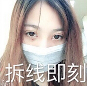 河南郑州美莱医院张主任做的全切+内眼角