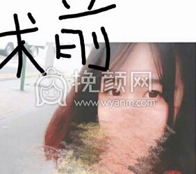 医院吕方中全切去皮去脂提肌