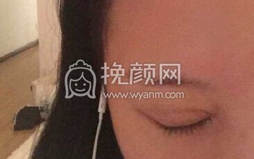 武汉中翰医院做的双眼皮