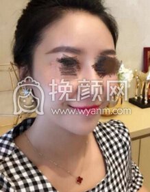 奕后胡晓静院长做的脂肪填充