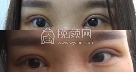 福建龙岩欧菲整形院长做的全切+开眼角