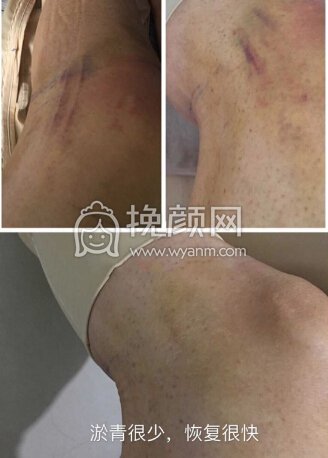 八大处顾云鹏医生做的大腿环吸