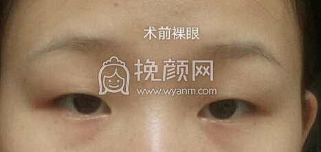 南昌皇美美容医院双眼皮+开眼角+提肌