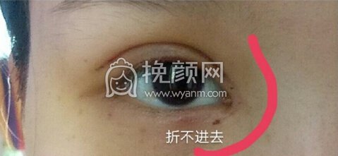 南昌皇美美容医院双眼皮+开眼角+提肌