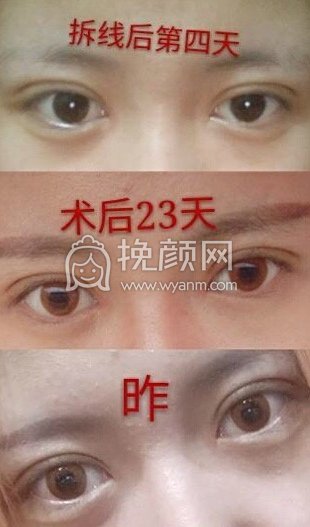 天津美莱毕小丽做的双眼皮全切开眼角+提肌