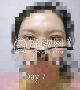 兰州时光整形美容医院庞主任做的双眼皮