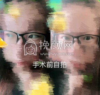 杭州浙一吴慧玲医生做的全切去皮去脂加眼角