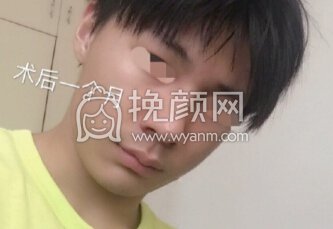 深圳李信锋鼻整形医院李信锋医生做的*